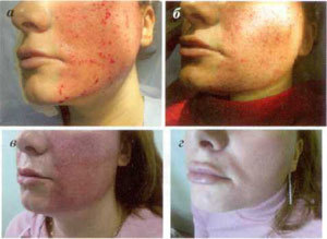Stages of skin recovery after fractional ablation