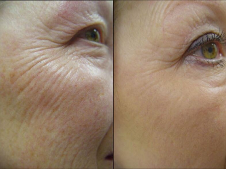 Before and after the laser rejuvenation procedure – significant reduction of wrinkles