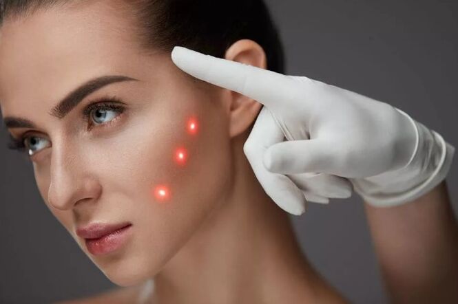 Laser Laser Renewal