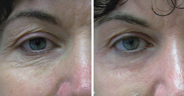 A leather laser around the eyes