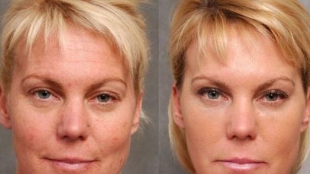 Before and after the recovery procedure