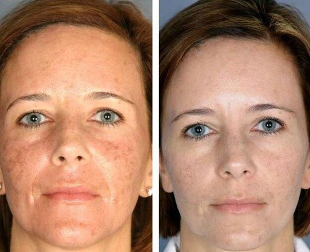 Laser recovery